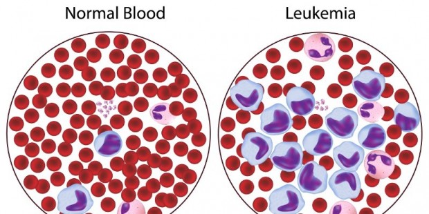 Informasi Leukemia Limfositik Akut » Medikalogi.com